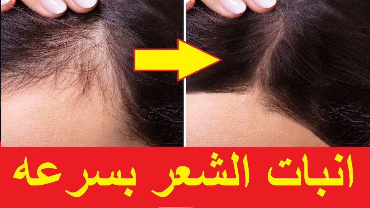 احصلي على شعر طويل وغزير.. وصفة لانبات فراغات الشعر بسرعة وعلاج التساقط شعرك لن يتوقف عن النمو 