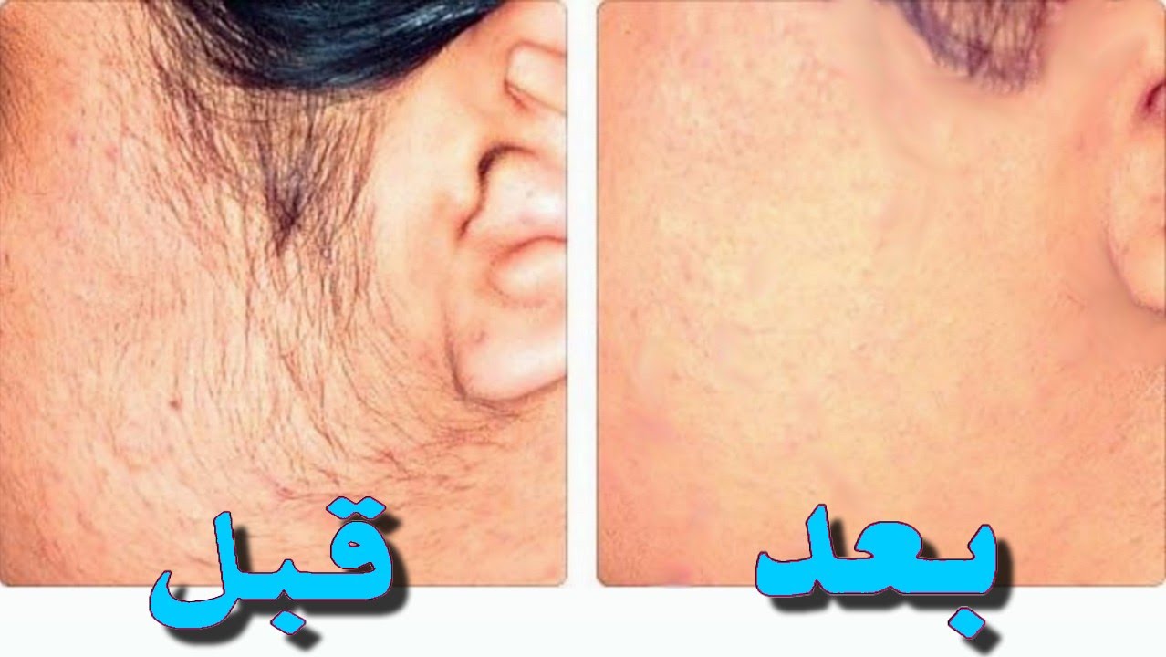 بدون ألم.. وصفة يابانية لإزالة الشعر الزائد من الوجه والجسم كله وتبيض فوري للمناطق الغامقة 