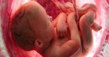 تسبب تشوه الجنين.. ما هى متلازمة السائل الأمينوسى