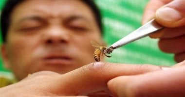 متى تستدعى “لدغات الحشرات” الذهاب لـ الطبيب.. علامات انتبه لها