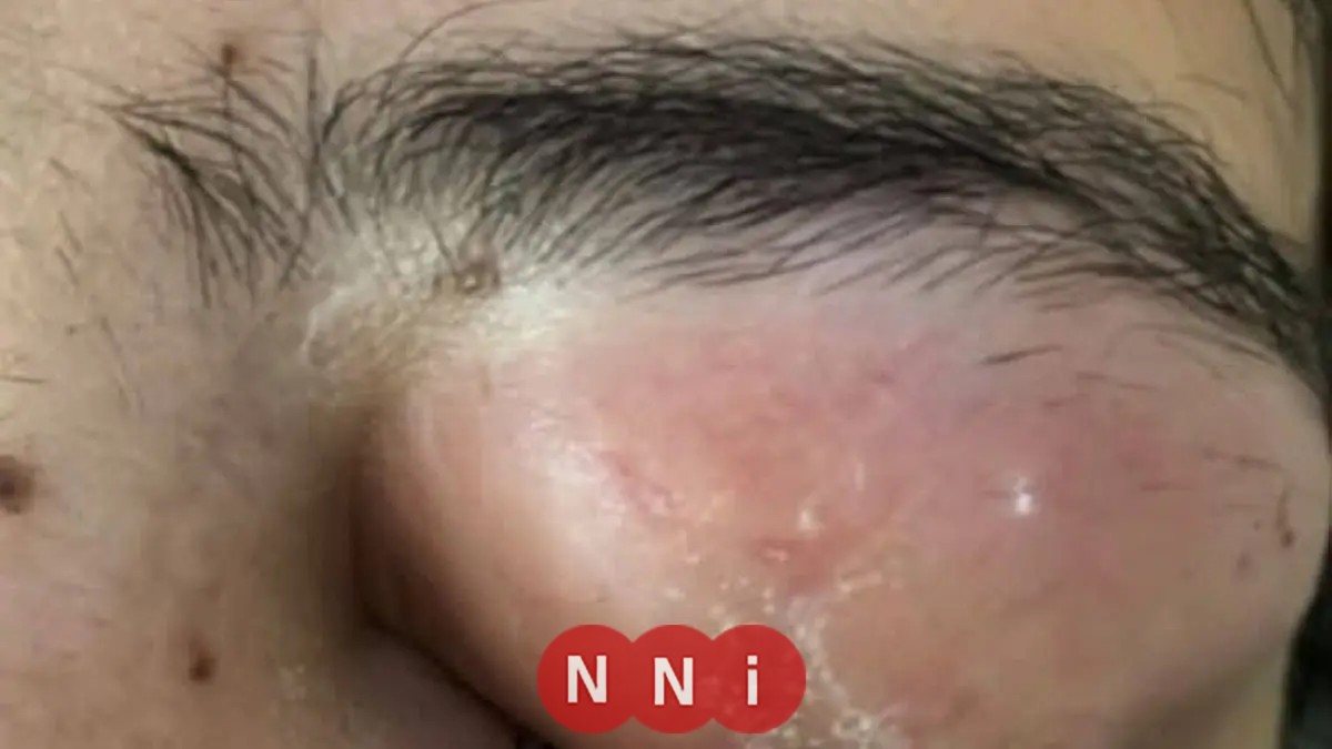 مستشفى جامعة الأزهر بأسيوط تنجح في إعادة البصر لمريضة بعد عقد من فقدانها