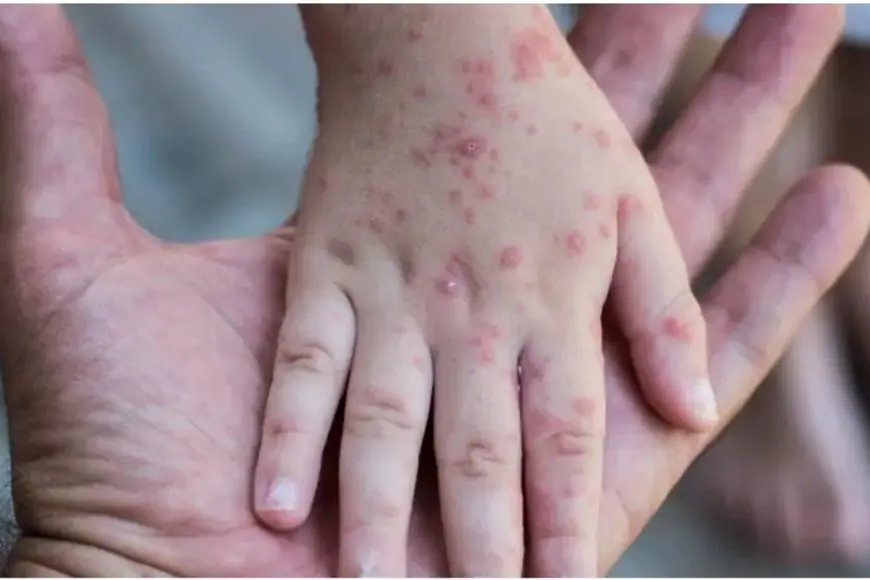 جدري القرود.. إجراءات حكومية مشددة لمواجهة تفشي المرض في مصر